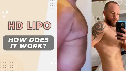 HD Lipo: What is it & who is it for? Plastic Surgeon Explains