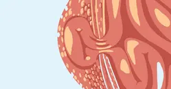 Hernia Basics and Spigelian Hernias