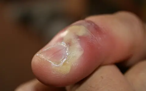 Herpetic Whitlow Infection