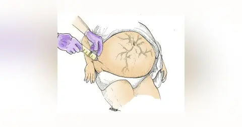 Mind The Gap Ep2: Part 2 of Paracentesis