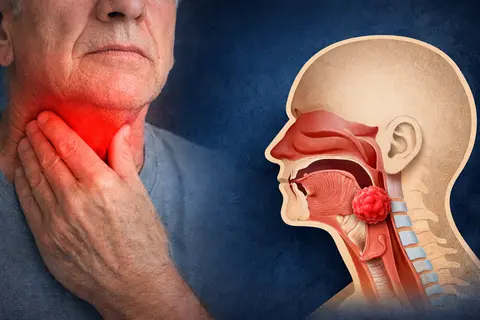 Laryngeal Cancer