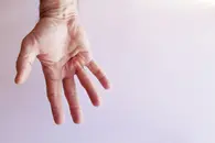 Dupuytren’s Contracture