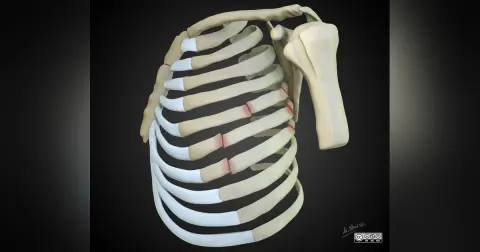 Episode 63 – Rib Fracture- An Interview with Dr. Patrick Maher