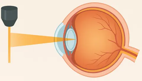 Laser Refractive Surgery