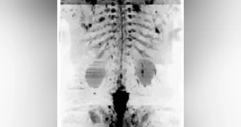 Quantitative whole-body diffusion weighted imaging for cancer