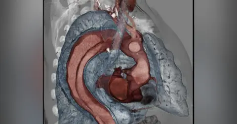 Episode 64 – Thoracic Aortic Syndromes- An Interview with Dr. Anthony Hackett