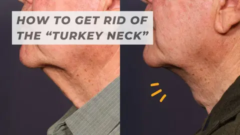 Bye-Bye, Turkey Neck: What Is The T-Z Plasty and Who Is It For?
