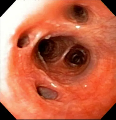 Eosinophilic Lung Disease - It’s a Thing