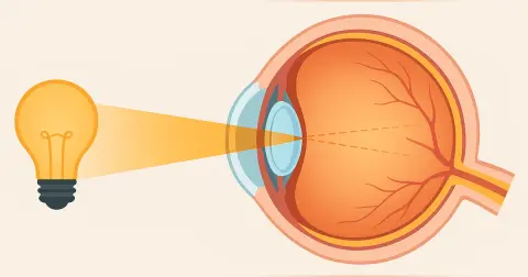 Refractive Errors, Eye Optics & Vision Correction Options