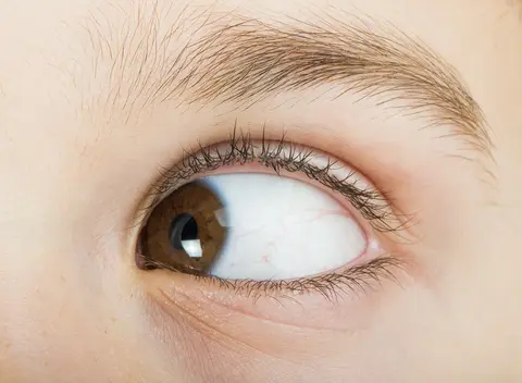 Strabismus