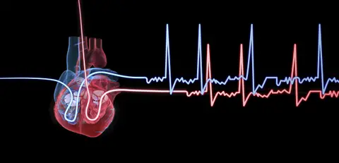Episode 57 – Atrial Fibrillation : An Approach To Diagnosis And Management In The Emergency Department