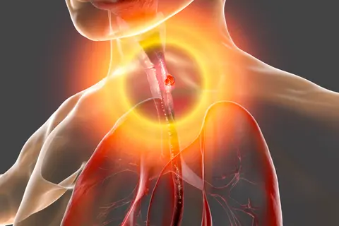 Clinical Presentation and Diagnosis of Esophageal Cancer
