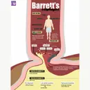 #33 Barrett's Esophagus: 5 Pearls