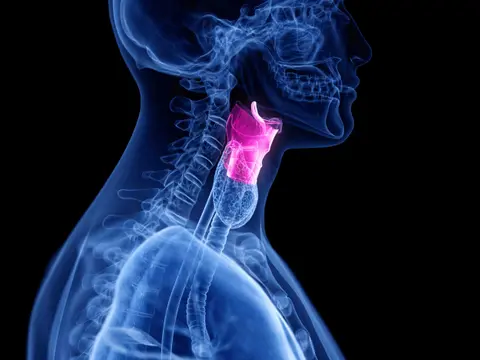 Vocal Fold Paralysis