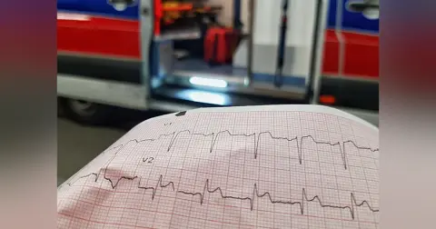 Episode 53- Evaluation and Management of ST-Segment Elevation Myocardial Infarction in the Emergency Department