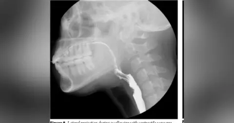 Radiopaque Episode: Modified Barium Swallow (MBS)