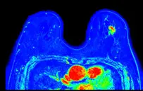 Episode 32: Breast MRI