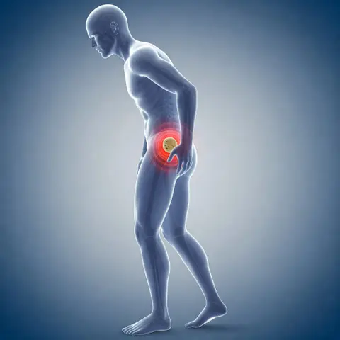 Renal Colic