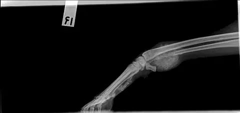 Quick and Easy Osteosarcoma Diagnosis