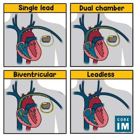 #123 Pacemakers & ICDs: 5 Pearls Segment