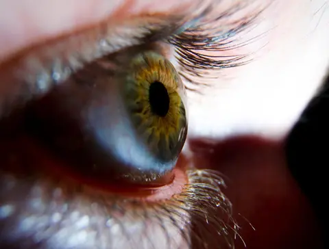 Corneal Transplant
