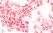 Conversation - Meningococcal Meningitis