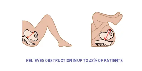 Shoulder Dystocia