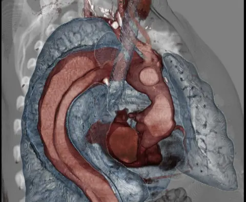 Episode 64 – Thoracic Aortic Syndromes- An Interview with Dr. Anthony Hackett
