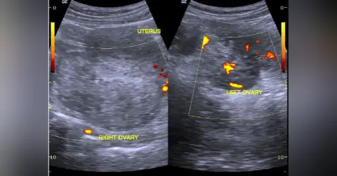 June 2020: Ovarian Torsion Myths