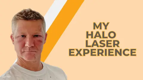 I’m a Plastic Surgeon, I had Halo Laser Treatment and Here’s What Happened (Part 1 of 3)