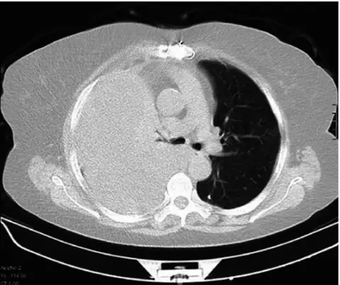 Small-bore vs Large-bore Chest Tubes in Hemothorax