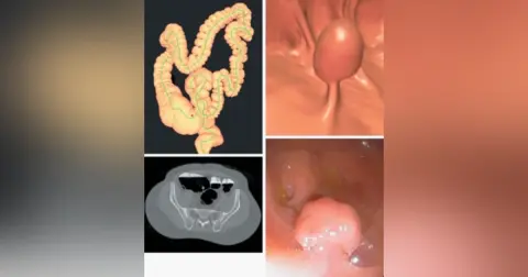 Episode 38 CT Colonography (CTC)