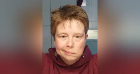 Facial Nerve Palsy Part 2