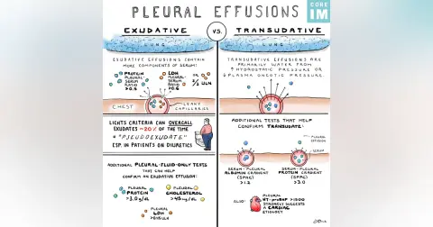 #182 Pleural Effusions: 5 Pearls Segment