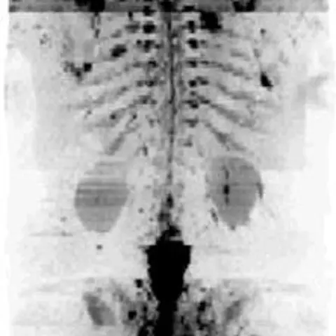 Quantitative whole-body diffusion weighted imaging for cancer