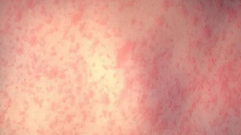 Why We Should Vaccinate Against Measles