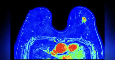 Episode 32: Breast MRI