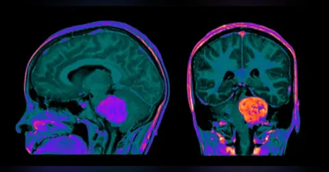 Episode 40 Neuro Protocols with Gadopiclenol
