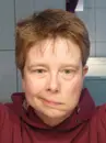 Facial Nerve Palsy Part 2