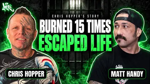 Life After Burning 13 Holes in My Leg & 2 in My Junk, and Escaping a Life Sentence, and Killing Myself in the Hospital