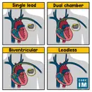 #123 Pacemakers & ICDs: 5 Pearls Segment