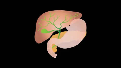 Biliary Colic and Cholecystitis