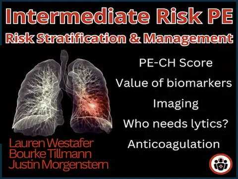 Ep 203 Intermediate Risk Pulmonary Embolism Risk Stratification, Management and Algorithm