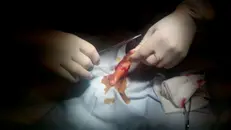 Assessment and Management of Traumatic Nail Bed Injuries