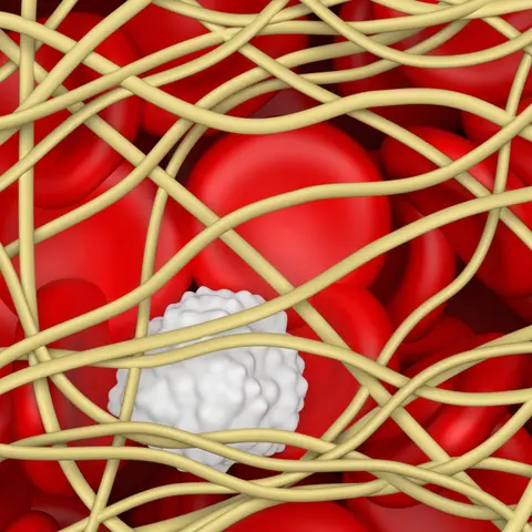 Pulmonary Embolism with Al Sacchettii, MD