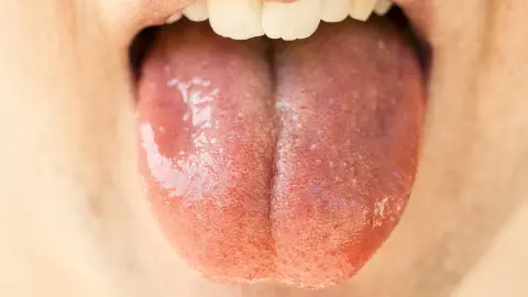 Oral Cavity Cancer
