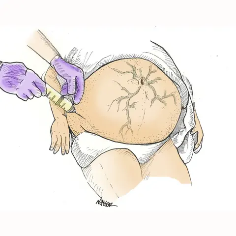 Mind The Gap Ep2: Part 2 of Paracentesis