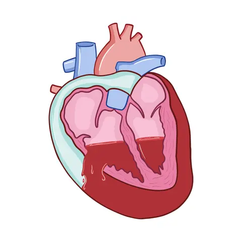 Cardiac Tamponade
