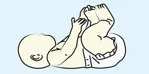 Meckel’s Diverticulum