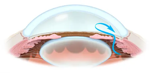 Ep 21 Talking About Glaucoma - 26Feb2013: Laser Iridotomy (mp3 version)